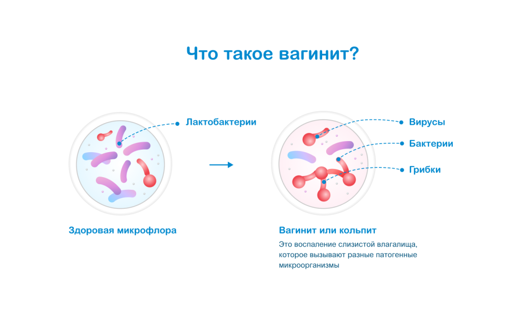 Что такое вагинит