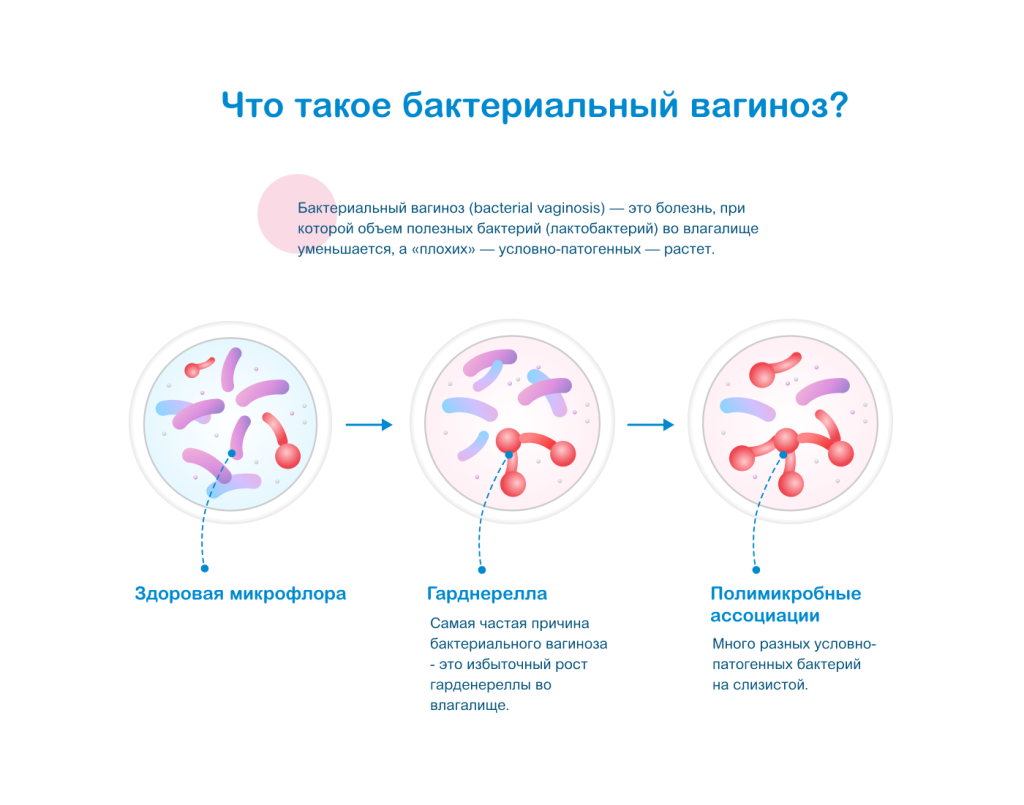 Что такое бактериальный вагиноз
