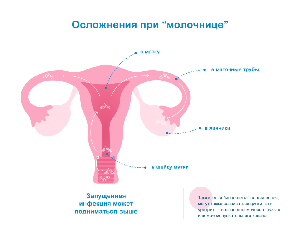 Осложнения при молочнице